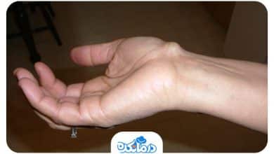 بیماری که در ناحیه پشت مچ دست دچار کیست گانگلیون شده است.