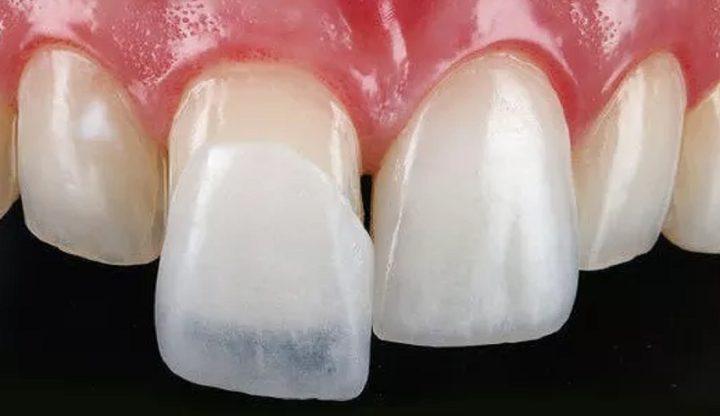 کامپوزیت دندان گران تر است یا لمینت دندان